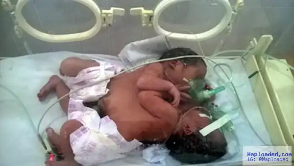 20-Year-Old Woman Who Was Unaware She Was Pregnant Gives Birth To Conjoined Twins